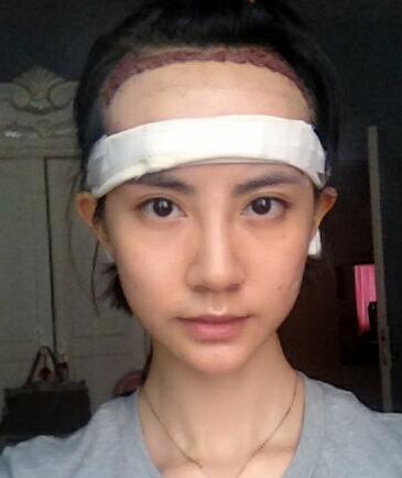 種頭發(fā)有用嗎?種植頭發(fā)恢復過程真實案例