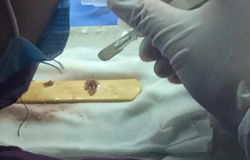 種頭發(fā)有用嗎?種植頭發(fā)恢復過程真實案例