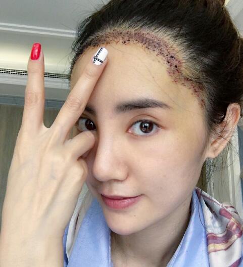 種頭發(fā)有用嗎?種植頭發(fā)恢復過程真實案例