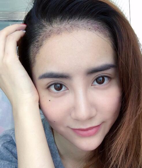 種頭發(fā)有用嗎?種植頭發(fā)恢復過程真實案例