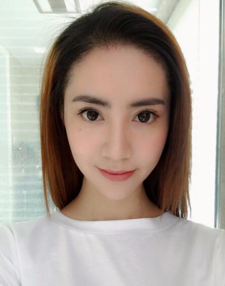 種頭發(fā)有用嗎?種植頭發(fā)恢復過程真實案例