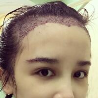 發(fā)際線種植果圖和經歷分享——南京明基整形醫(yī)院