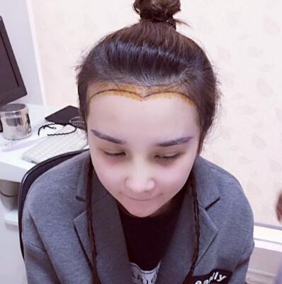 發(fā)際線種植果圖和經(jīng)歷分享——南京明基整形醫(yī)院