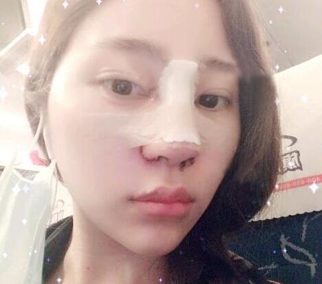 隆鼻整形前后對比圖和恢復(fù)過程