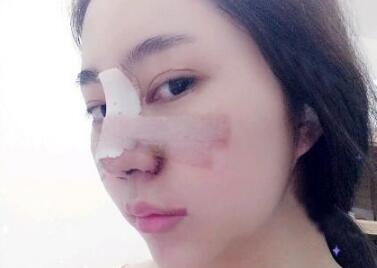 隆鼻整形前后對比圖和恢復(fù)過程