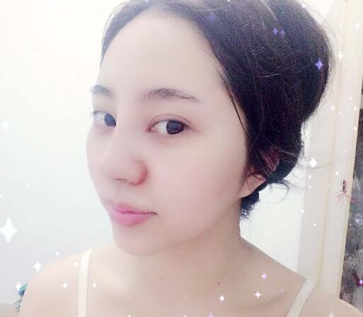 隆鼻整形前后對比圖和恢復(fù)過程