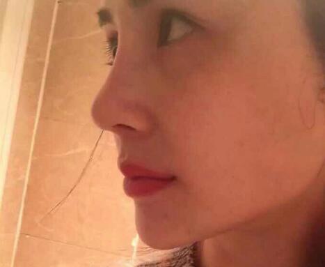 鼻子綜合整形前后對比圖，恢復(fù)過程