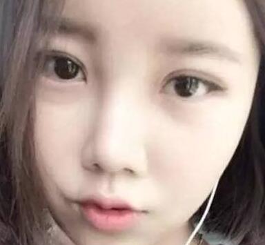 雙眼皮整形前后對比圖,單眼皮變雙眼皮整容日記