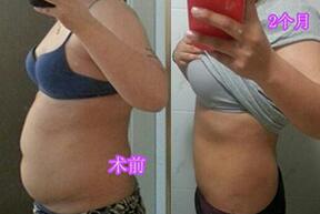 吸脂減肥前后對(duì)比圖