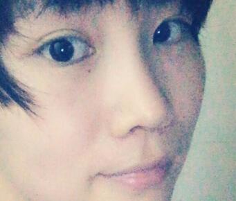 杭州悅可整形醫(yī)院做隆鼻失敗修復(fù)恢復(fù)過程和對比圖分享