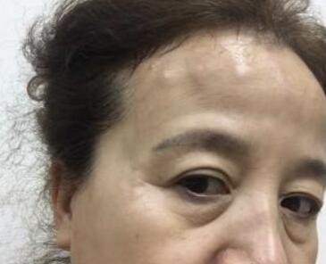 去抬頭紋很好的方法？注射瘦臉去抬頭紋魚尾紋