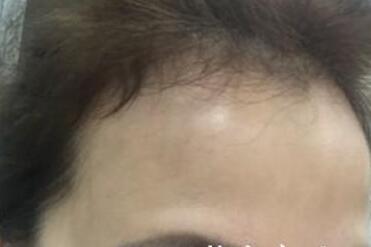 去抬頭紋很好的方法？注射瘦臉去抬頭紋魚尾紋