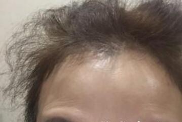 去抬頭紋很好的方法？注射瘦臉去抬頭紋魚尾紋