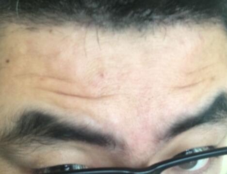 男生注射注射瘦臉去除抬頭紋魚尾紋案例分享