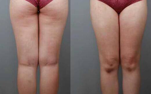 吸脂減肥瘦大腿前后對比圖,光纖溶脂瘦大腿較有的方法真實案例