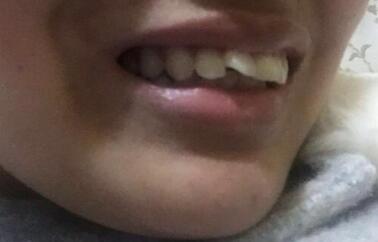 在成都圣貝牙科醫(yī)院做了兩顆純鈦烤瓷牙價(jià)格4800元