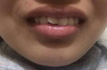 在成都圣貝牙科醫(yī)院做了兩顆純鈦烤瓷牙價(jià)格4800元