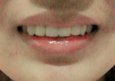 在成都圣貝牙科醫(yī)院做了兩顆純鈦烤瓷牙價(jià)格4800元