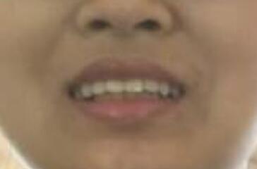 在成都圣貝牙科醫(yī)院做了兩顆純鈦烤瓷牙價(jià)格4800元