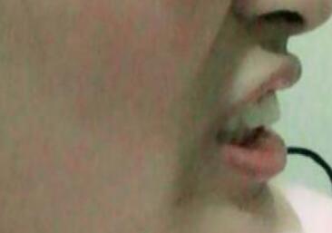 在成都圣貝牙科醫(yī)院做了兩顆純鈦烤瓷牙價(jià)格4800元