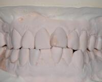 成都圣貝口腔醫(yī)院做了全冠修復(fù)，牙齒排齊美白前后對比果圖