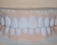 成都圣貝口腔醫(yī)院做了全冠修復(fù)，牙齒排齊美白前后對比果圖