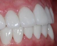 成都圣貝口腔醫(yī)院做了全冠修復(fù)，牙齒排齊美白前后對比果圖