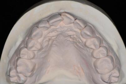 成都圣貝口腔醫(yī)院做了全冠修復(fù),牙齒排齊美白前后對比果圖