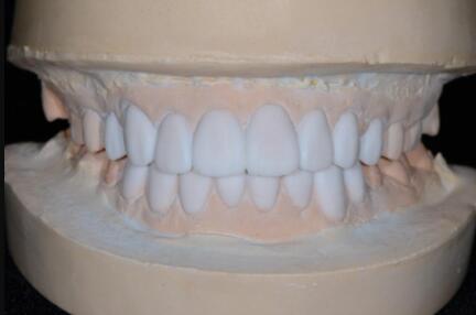 成都圣貝口腔醫(yī)院做了全冠修復(fù),牙齒排齊美白前后對比果圖