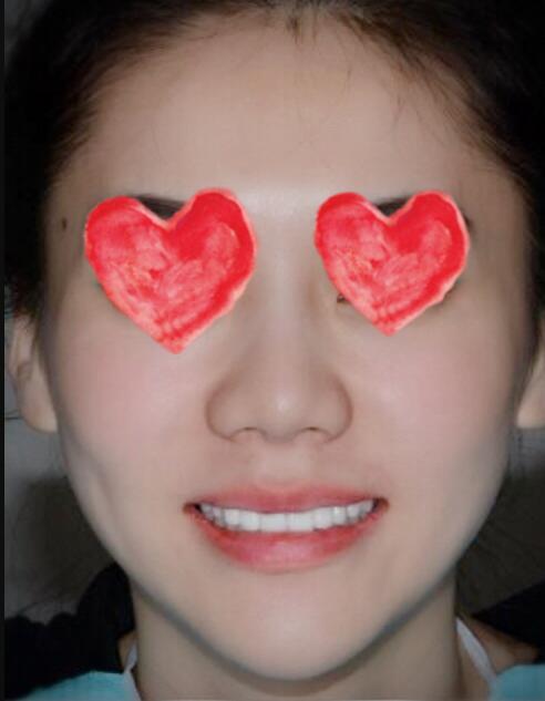 成都圣貝口腔醫(yī)院做了全冠修復(fù),牙齒排齊美白前后對比果圖