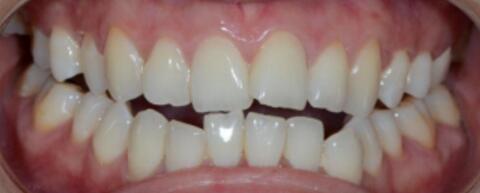 成都圣貝口腔醫(yī)院做了全冠修復(fù),牙齒排齊美白前后對比果圖