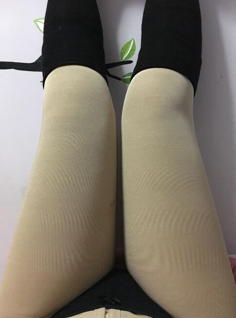 水動力吸脂減肥瘦大腿手術(shù)前后對比圖和恢復(fù)過程