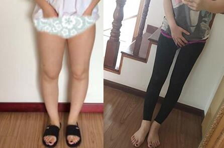 北京大腿吸脂減肥多少錢？哪家整形醫(yī)院好？正規(guī)醫(yī)院推薦