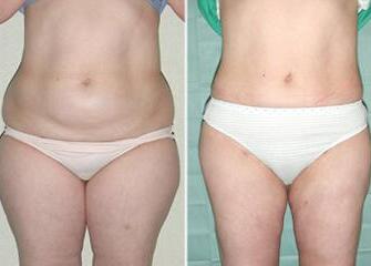 吸脂減肥前后對(duì)比