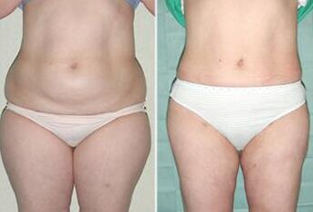 吸脂減肥前后對(duì)比照