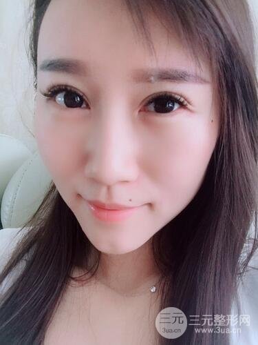 雙眼皮修復(fù)術(shù)案例圖 前后果對比--青島諾德