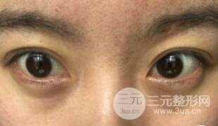 真人內(nèi)切去眼袋手術(shù)過(guò)程對(duì)比圖片和案例分享