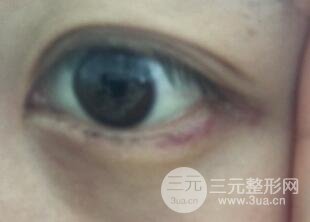真人內(nèi)切去眼袋手術(shù)過(guò)程對(duì)比圖片和案例分享