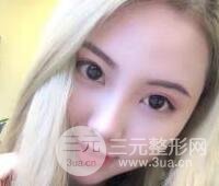 開內(nèi)眼角和三點(diǎn)定位雙眼皮恢復(fù)過程圖片真人案例分享