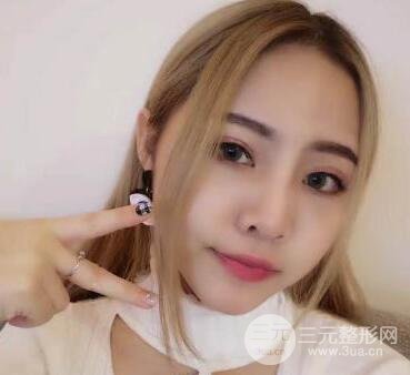 開內(nèi)眼角和三點定位雙眼皮恢復(fù)過程圖片真人案例分享
