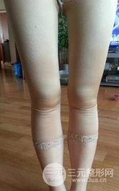 全身吸脂減肥前后對比圖和恢復(fù)過程真實案例分享