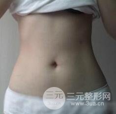 全身吸脂減肥前后對比圖和恢復(fù)過程真實案例分享