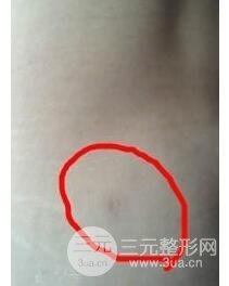 全身吸脂減肥前后對比圖和恢復(fù)過程真實案例分享