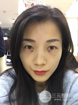 分享我的激光祛眼袋手術前后過程，廈門思明安黛美林韻醫(yī)生做的