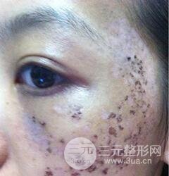 做了三次激光去太田痣，后來的果已經(jīng)是我較為滿意的了。
