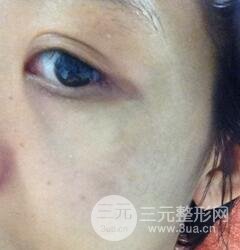 做了三次激光去太田痣，后來的果已經(jīng)是我較為滿意的了。