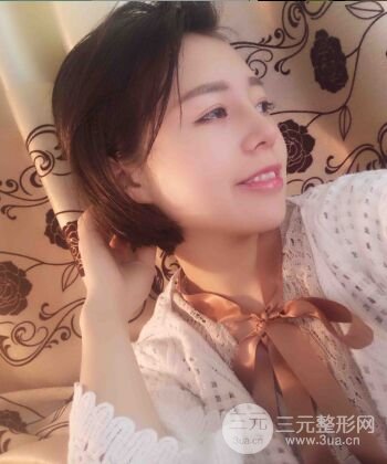 硅膠假體隆鼻+耳軟骨墊鼻尖四個月恢復(fù)果圖