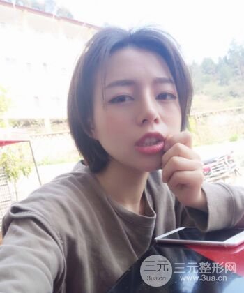 硅膠假體隆鼻+耳軟骨墊鼻尖四個月恢復(fù)果圖