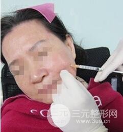 自從打了膠原蛋白除皺以后，都說我年輕多了