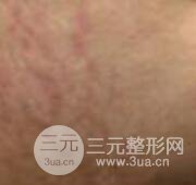 果酸換膚去妊娠紋真人案例和妊娠紋整形手術(shù)前后對比圖